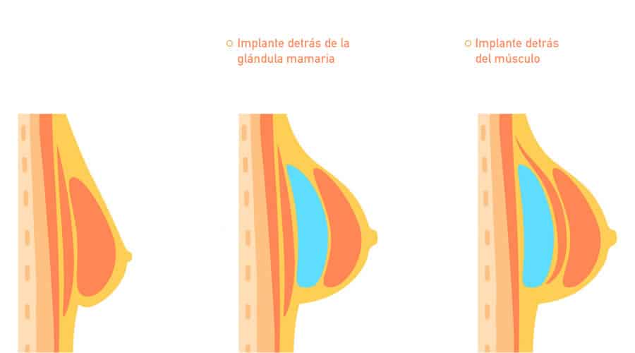 Rinoplastia antes y después Dr Fernando Ruiz